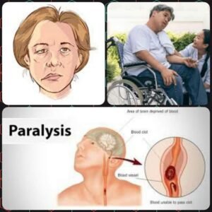 What is the main cause of paralysis?